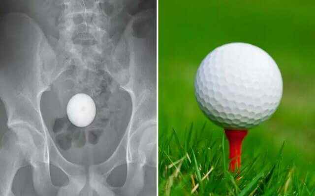 Doctors were stunned When he couldnt get the golf ball