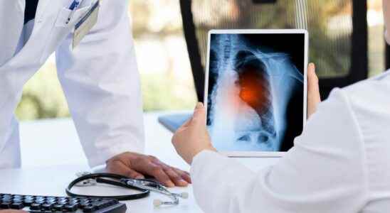 Lung cancer artificial intelligence capable of predicting cancer 6 years