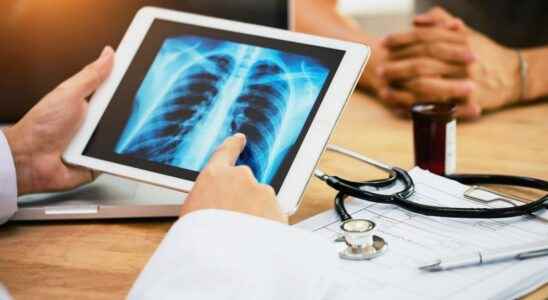 Lung cancer in 20 years the survival rate has improved