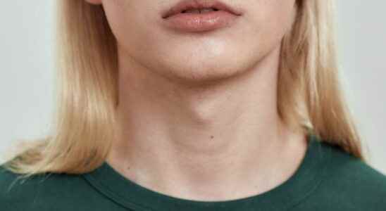 Removal of Adams apple unfolding risks