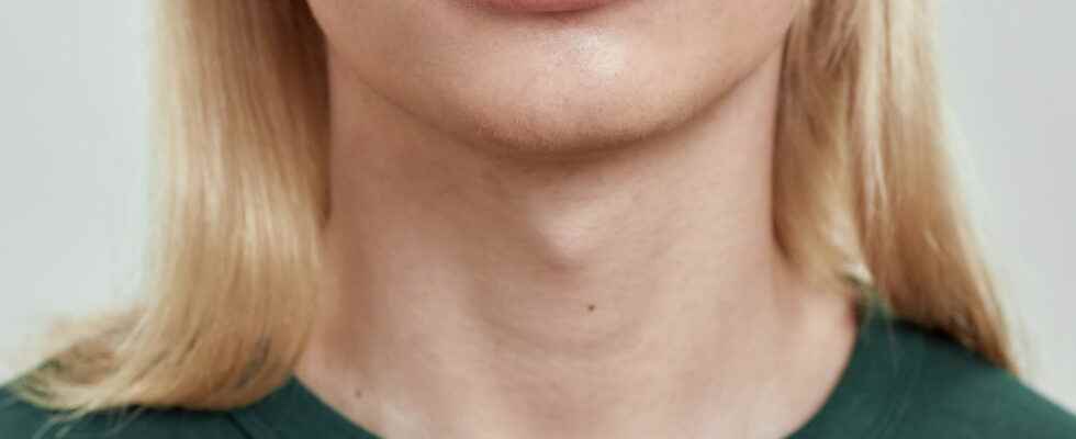 Removal of Adams apple unfolding risks