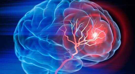 Stroke thrombectomy also improves the most serious cases