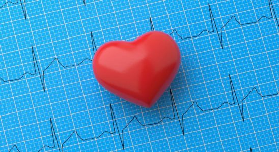 Atrial fibrillation linked to increased risk of dementia