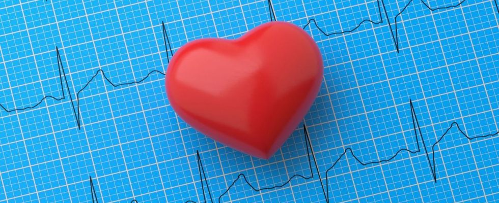 Atrial fibrillation linked to increased risk of dementia