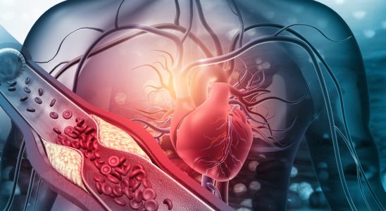 BMC definition and symptoms of obstructive cardiomyopathy