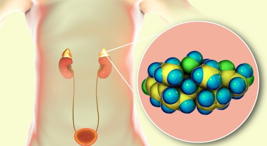 Cushings disease what is it life expectancy or syndrome