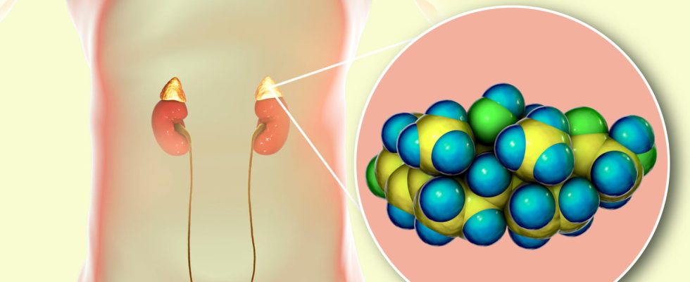 Cushings disease what is it life expectancy or syndrome