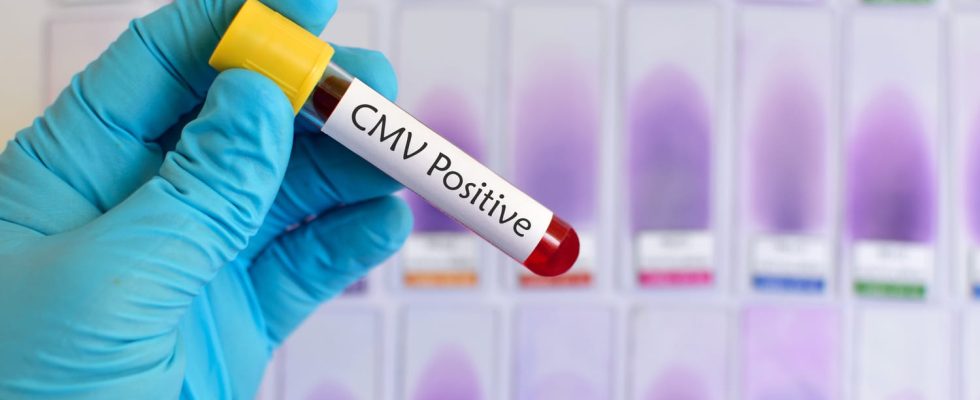 Cytomegalovirus CMV positive IgGIgM interpretation