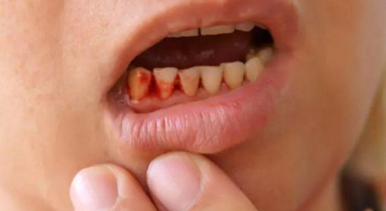 Dont be trivial Gum bleeding warns of risky disease