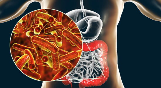 Dysentery amoebic bacillary what causes is it fatal