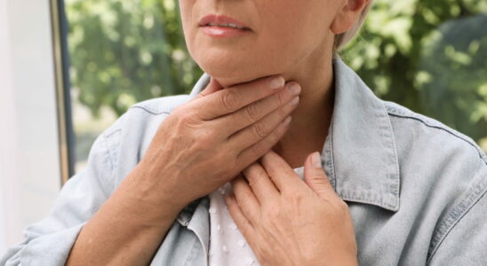 Goiter photo symptoms of an increased thyroid