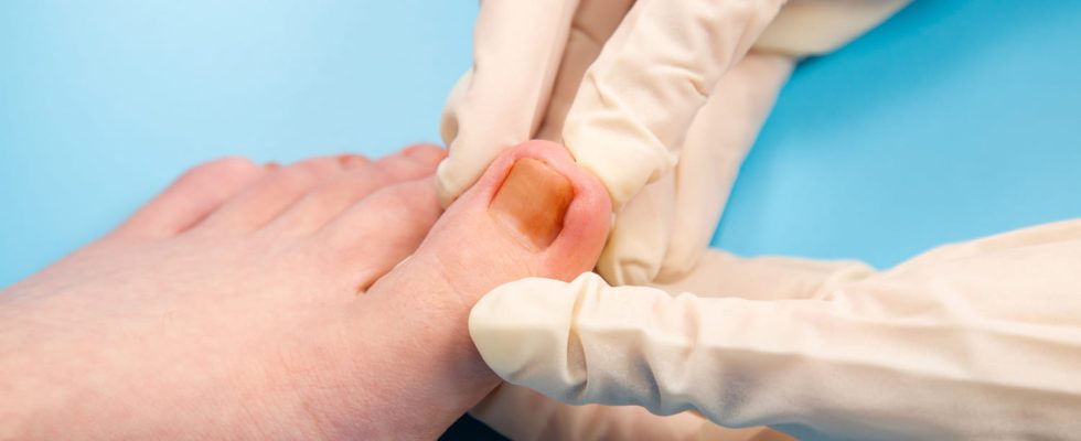 How to treat an ingrown toenail foot hand