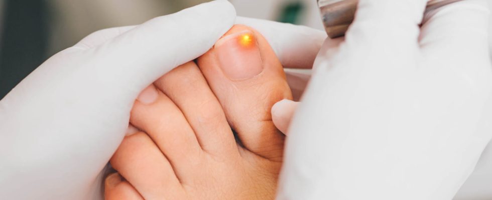 How to treat nail fungus hand foot