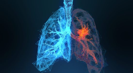 Lung cancer in non smokers causes and prognosis