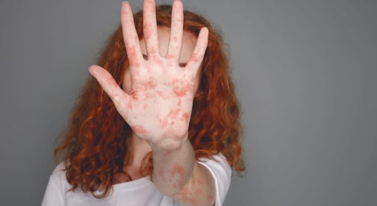 Measles in adults symptoms treatments incubation