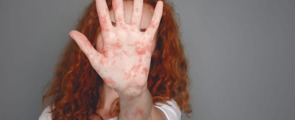 Measles in adults symptoms treatments incubation