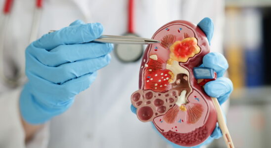 Nephrologist the kidney specialist role when to see him