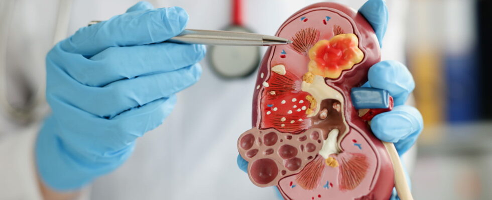 Nephrologist the kidney specialist role when to see him