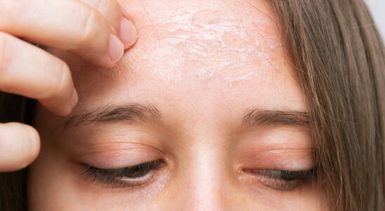 Peeling skin desquamation why how to remove it