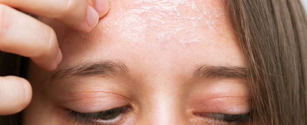 Peeling skin desquamation why how to remove it