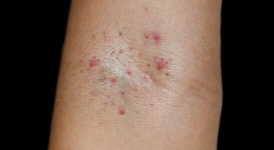 Petechiae small red spots causes when to worry