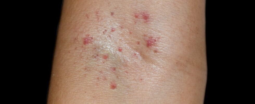 Petechiae small red spots causes when to worry