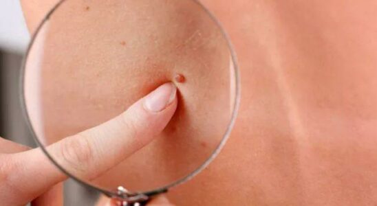 Turkish researchers found Unknown symptom of diabetes on the skin