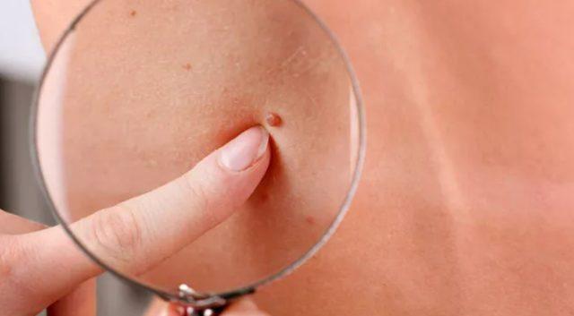 Turkish researchers found Unknown symptom of diabetes on the skin