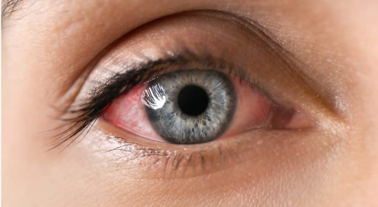 Uveitis symptoms healing time is it serious