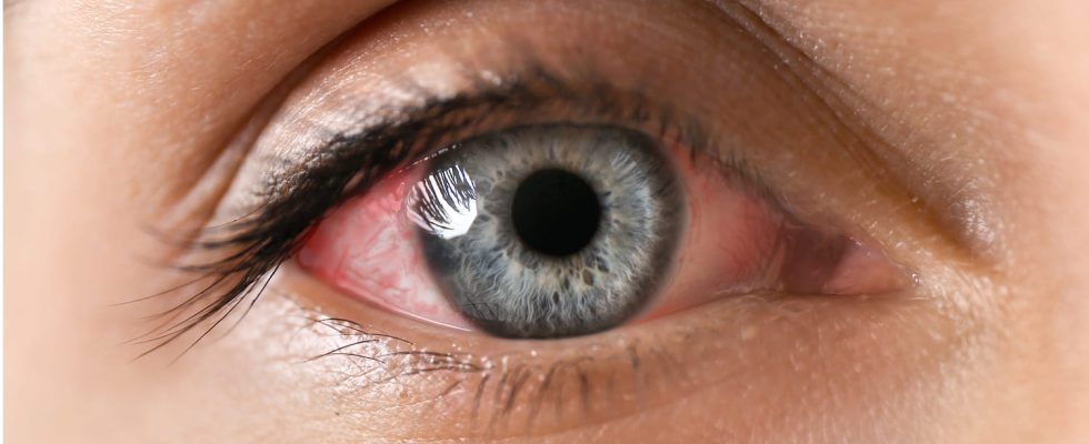 Uveitis symptoms healing time is it serious