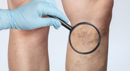 What are the symptoms of venous insufficiency