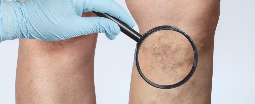 What are the symptoms of venous insufficiency