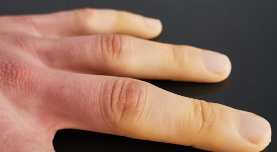 White fingertips Raynauds syndrome