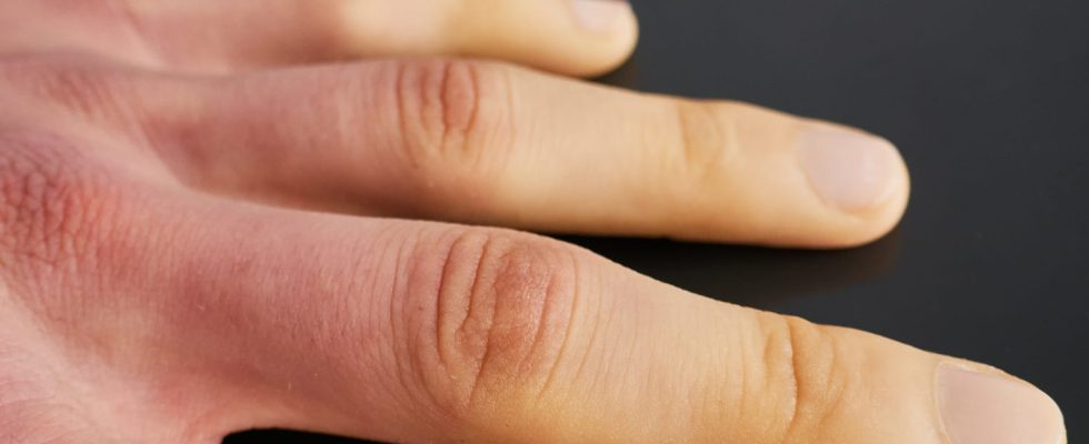 White fingertips Raynauds syndrome