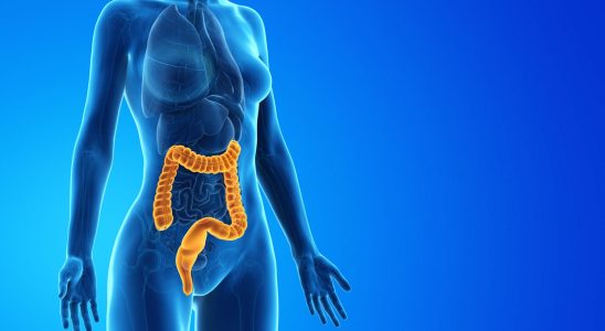 Acute colitis symptoms duration is it serious