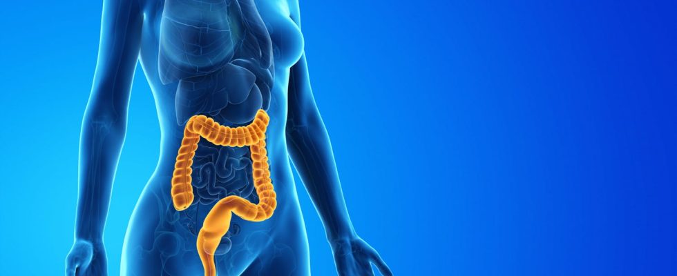 Acute colitis symptoms duration is it serious