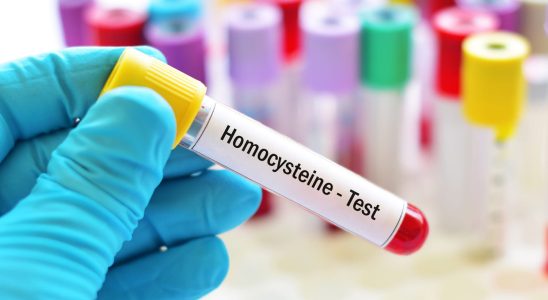 Analysis of homocysteine role high rate why