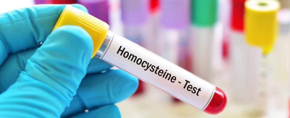 Analysis of homocysteine role high rate why