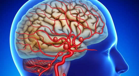 Aneurysm aorta brain cause symptoms what is it