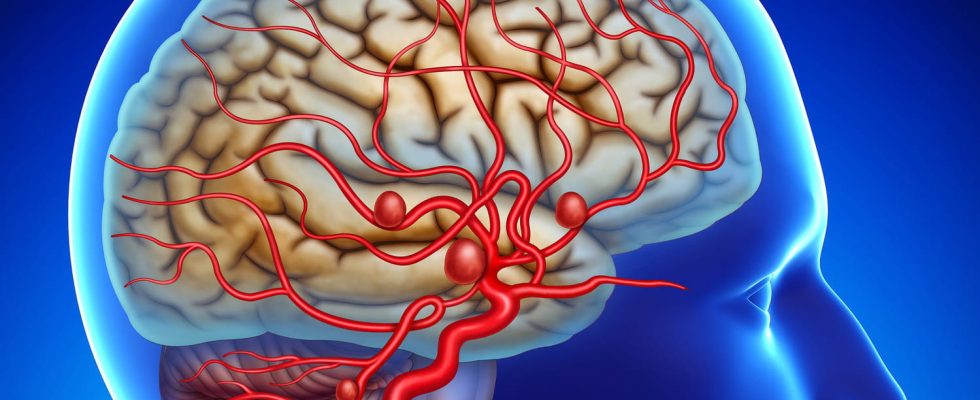 Aneurysm aorta brain cause symptoms what is it