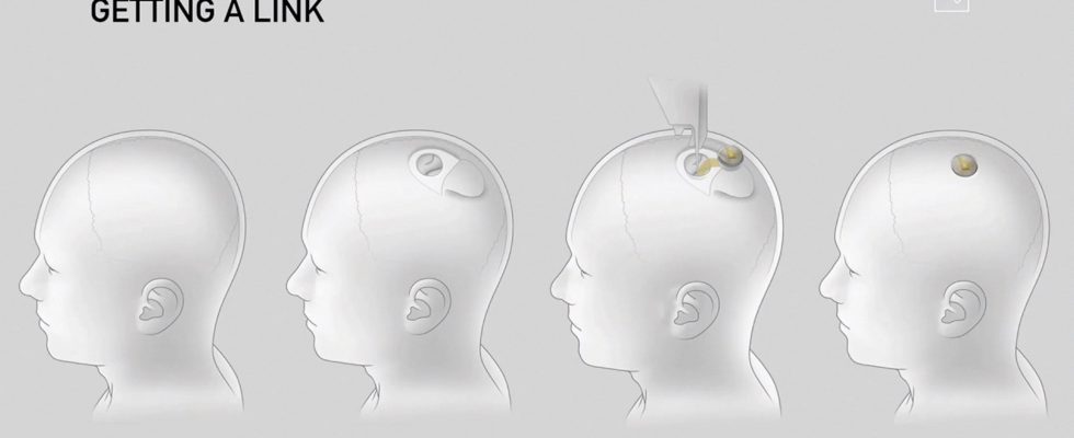 Brain implants behind innovation these questions that arise