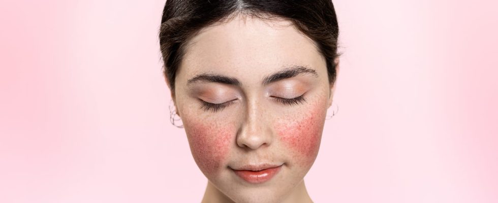 Couperose rosacea what are the effective treatments