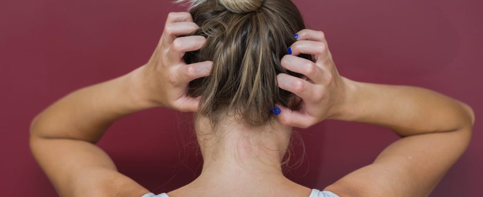 Effective treatments for scalp psoriasis