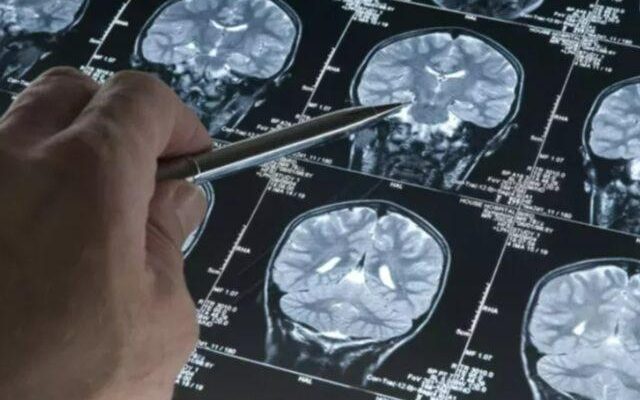 The first sign of Alzheimers disease seen years ago Notice