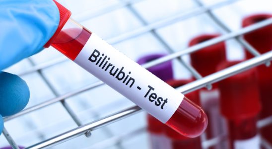 Total free conjugated bilirubin when to worry