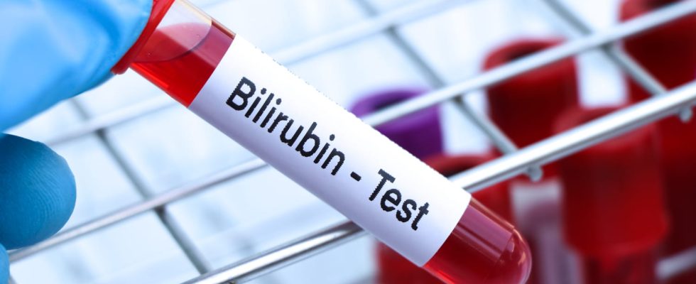 Total free conjugated bilirubin when to worry