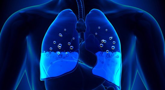 Water in the lung how to treat pulmonary edema