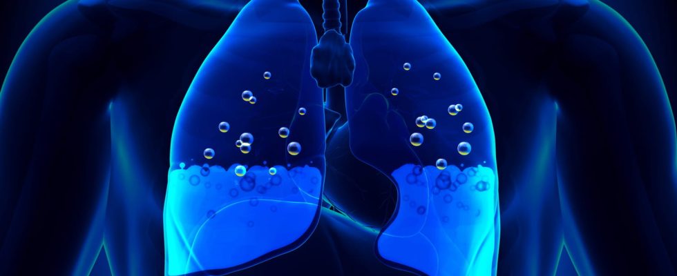 Water in the lung how to treat pulmonary edema