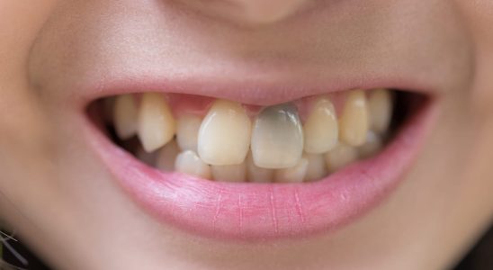 8 causes of brown or brown stains on teeth and