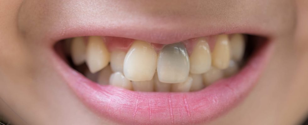 8 causes of brown or brown stains on teeth and